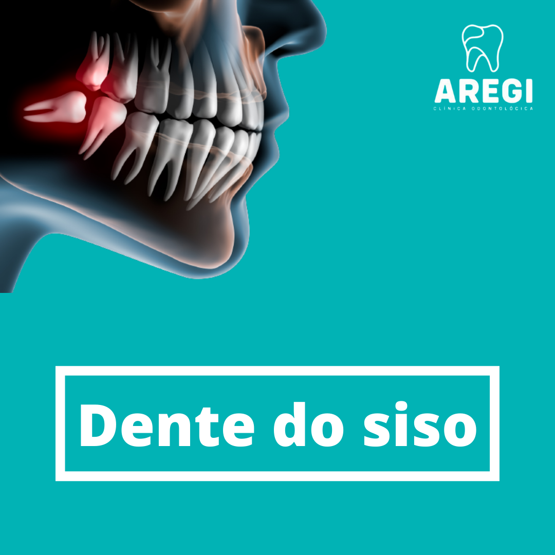 Dente do siso ou Terceiro molar